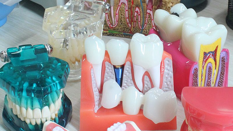 全瓷牙材质对比：氧化锆与玻璃陶瓷的优劣解析